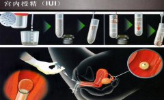 人工授精和试管婴